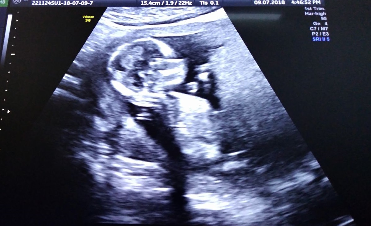 first baby, second trimester, ultrasound, listening to babys heartbeat, granny in waiting, first grandchild, ovia app, knitting for babies