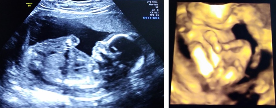 ultrasound, peanut is on the way